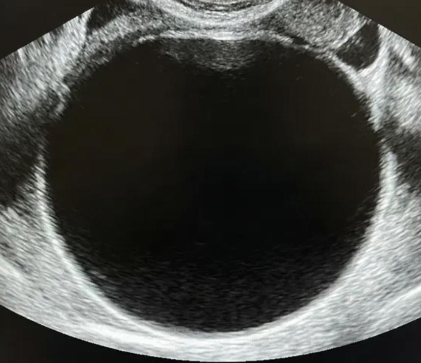 Ilustração: Cisto unilocular ≥ 10 cm (simples ou não simples)